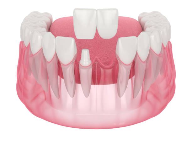 Upper teeth, several missing, showing dental work gap. Gum pink, teeth white.