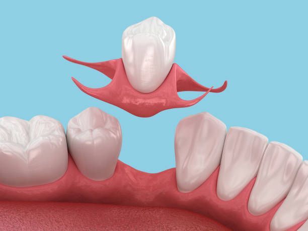 Partial dentures, pink and white, with metal clasps.