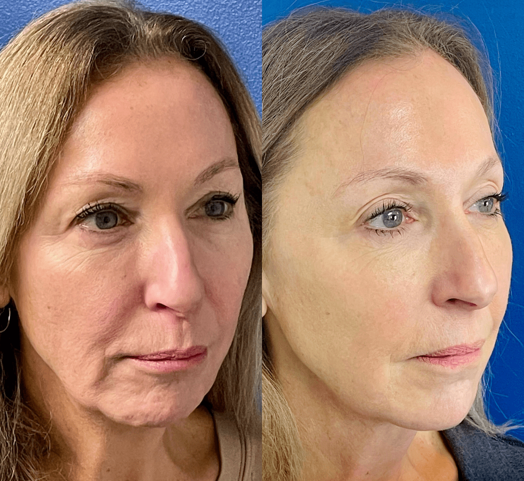 Renuva before and after of a woman's face