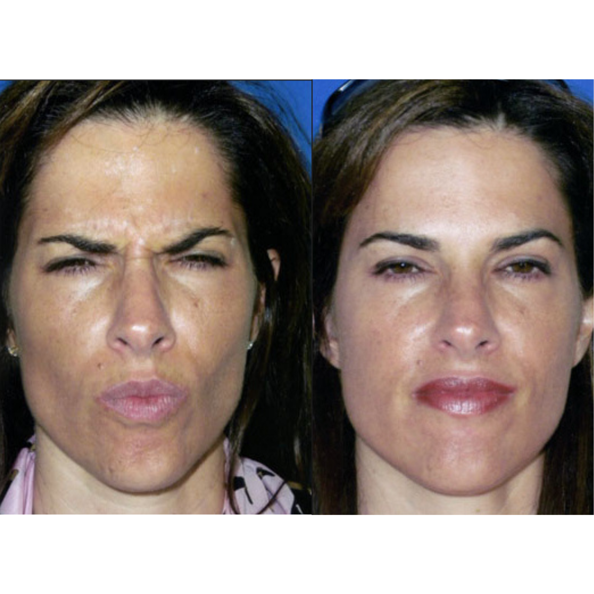 Neurotoxin before and after of a woman's face