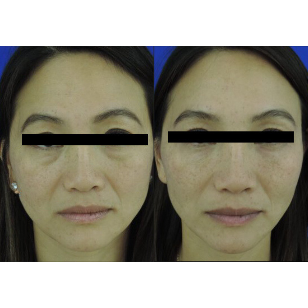 Dermal filler before and after of a woman's face