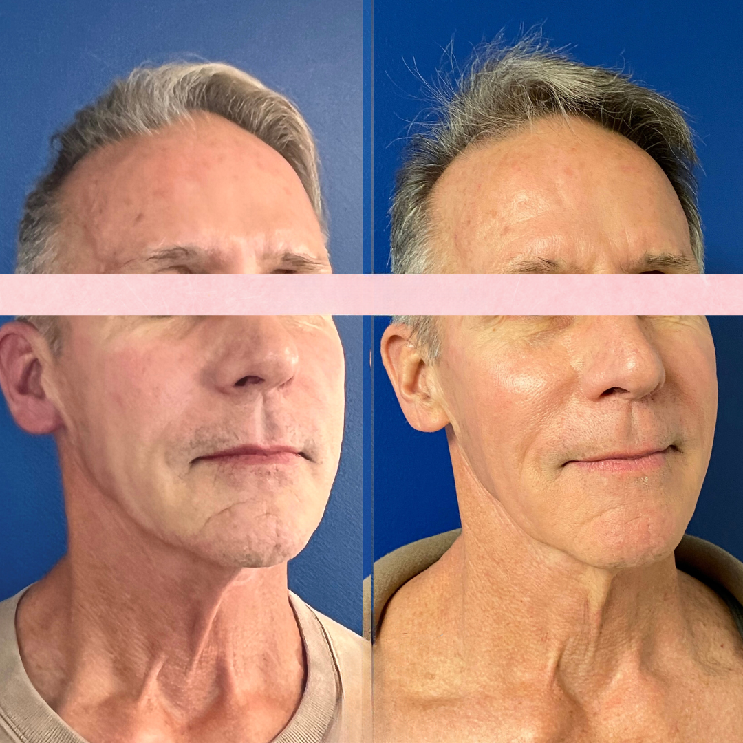 Sculptra before and after of a man's face