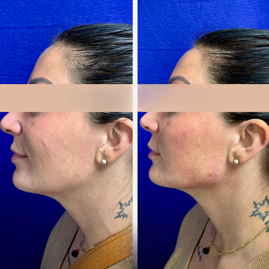 Dermal filler before and after of a woman's face