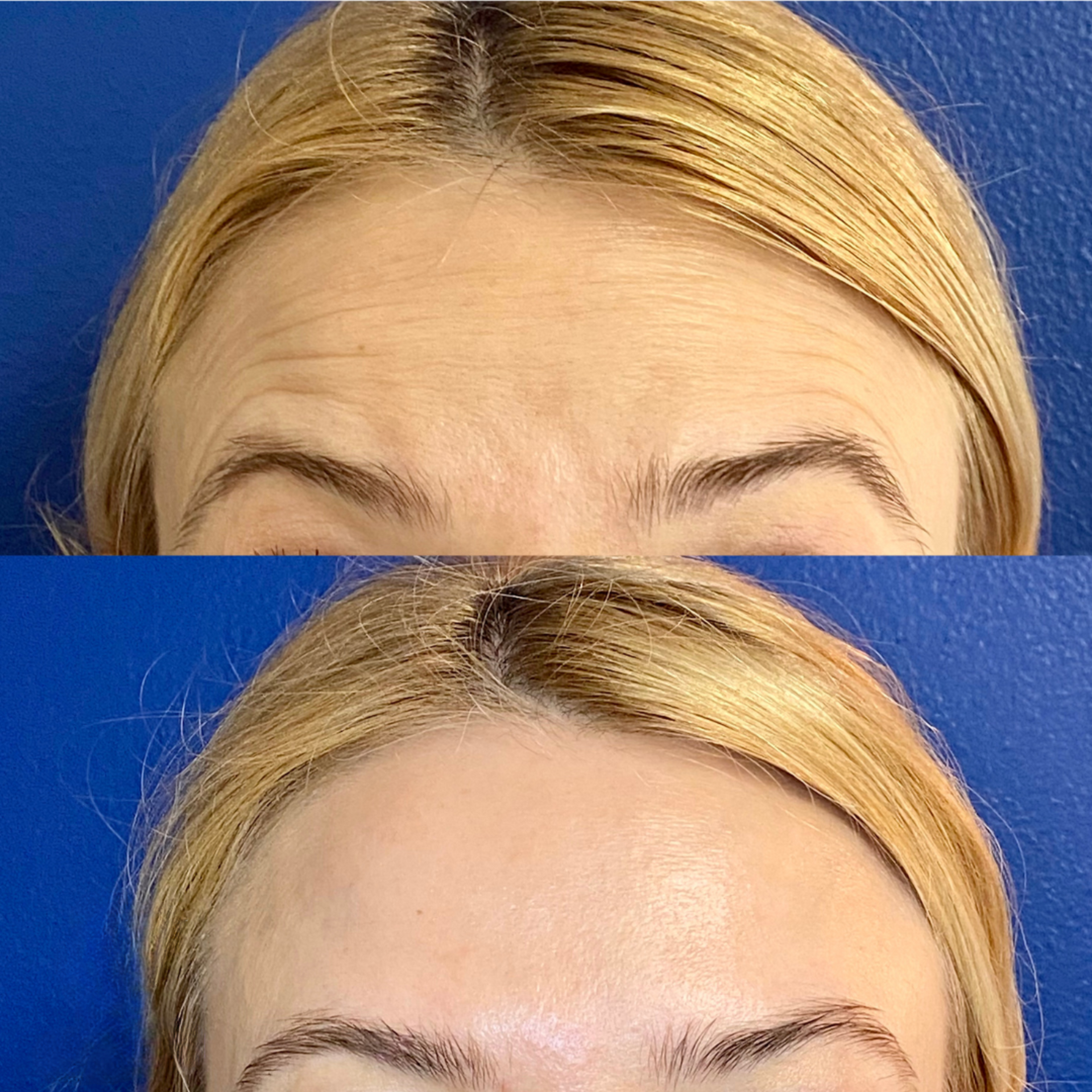 Neurotoxin before and after of a woman's forehead