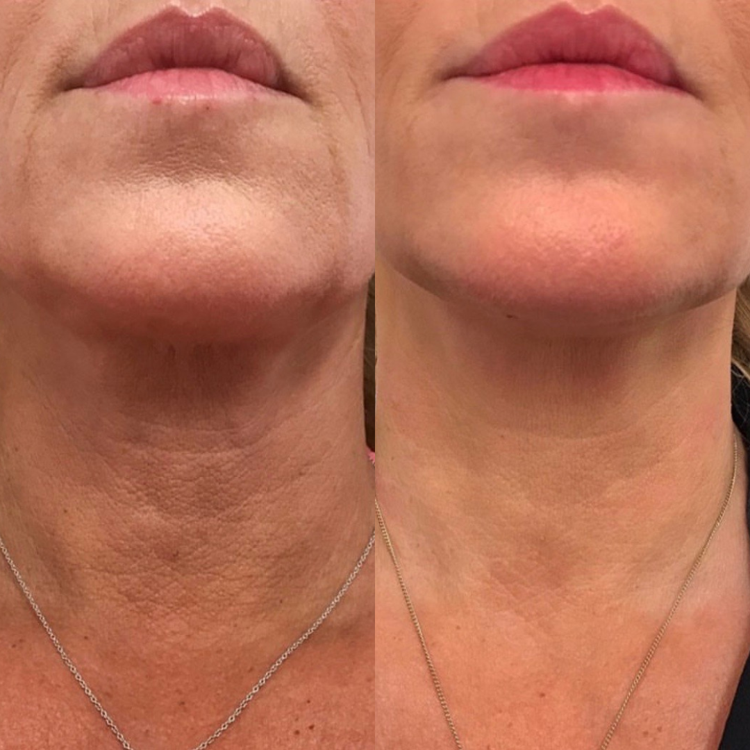 Filler before and after of a woman's neck