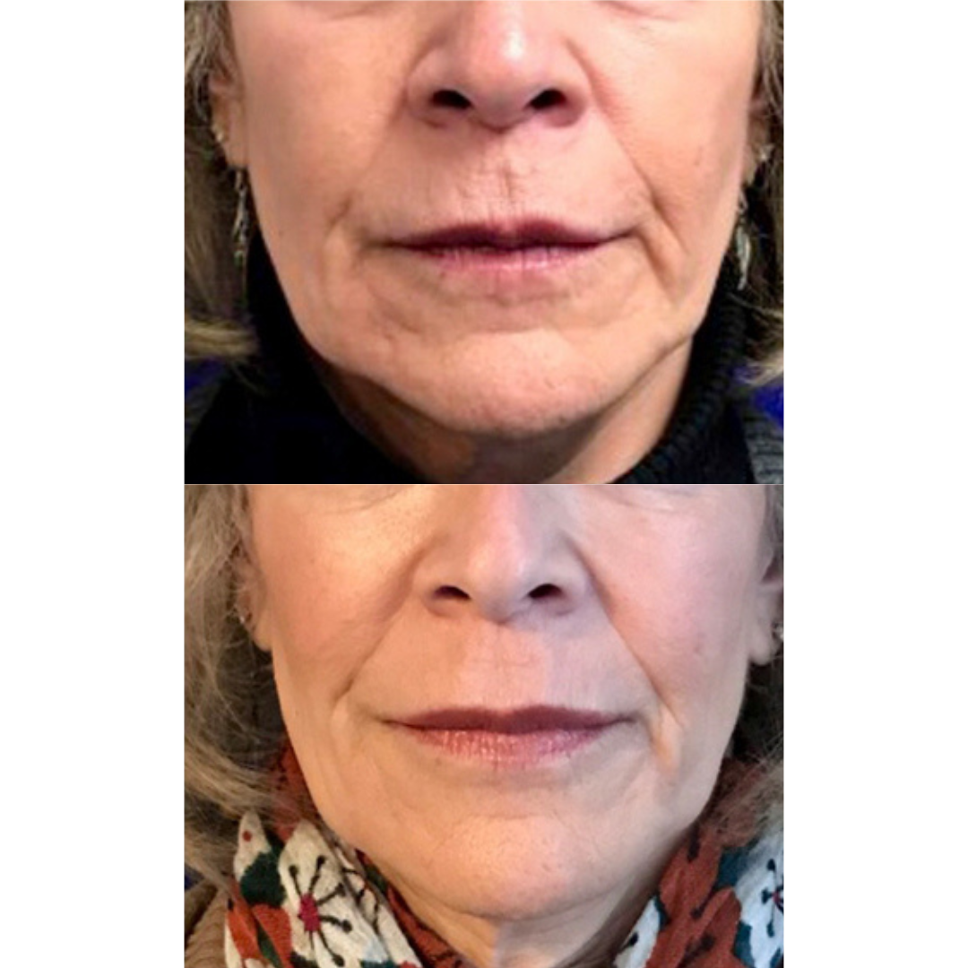 Lip filler before and after