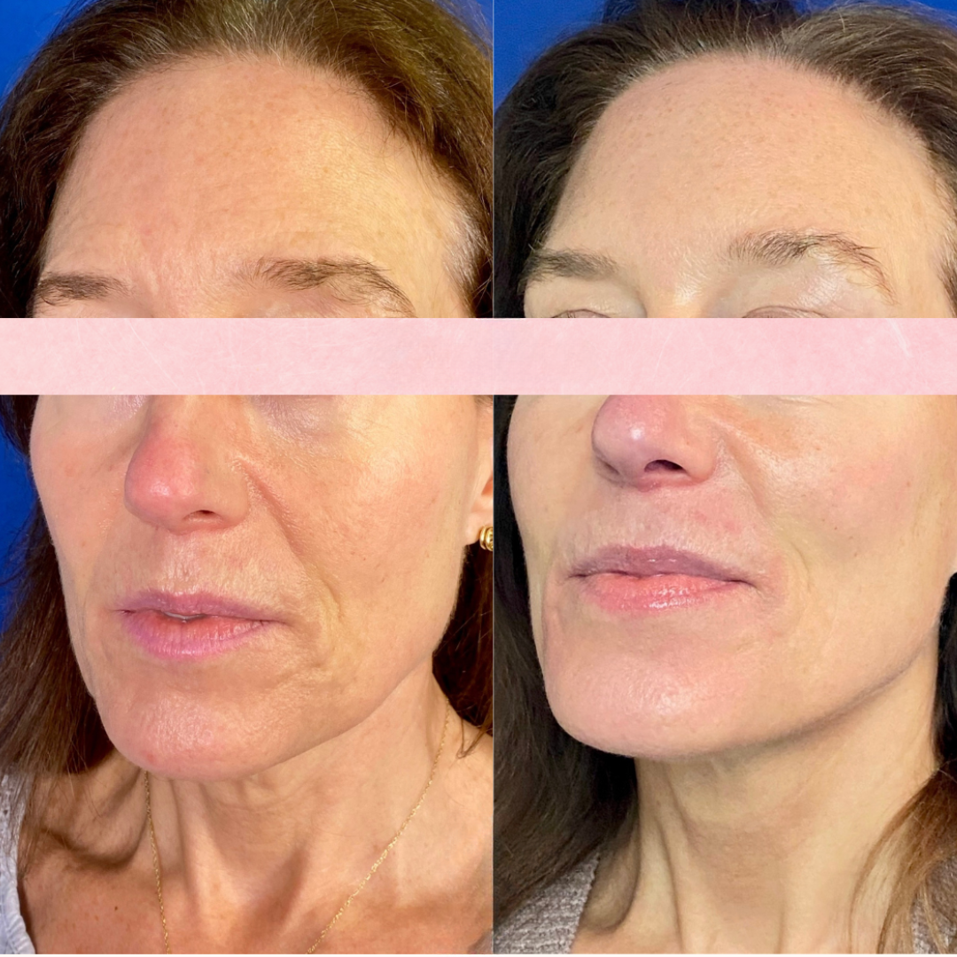 Sculptra before and after of a woman's face