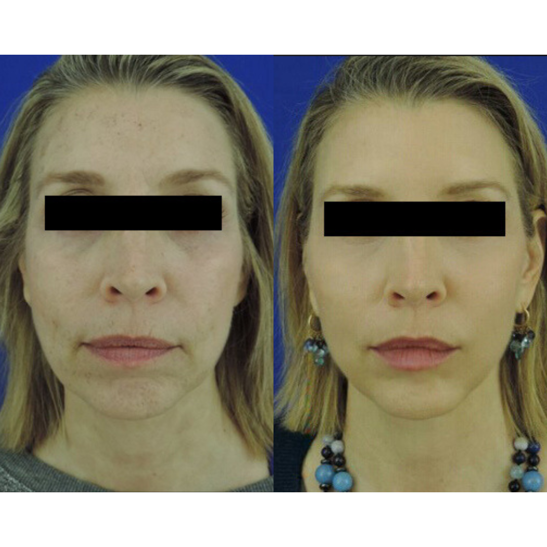 Dermal filler before and after of a woman's face