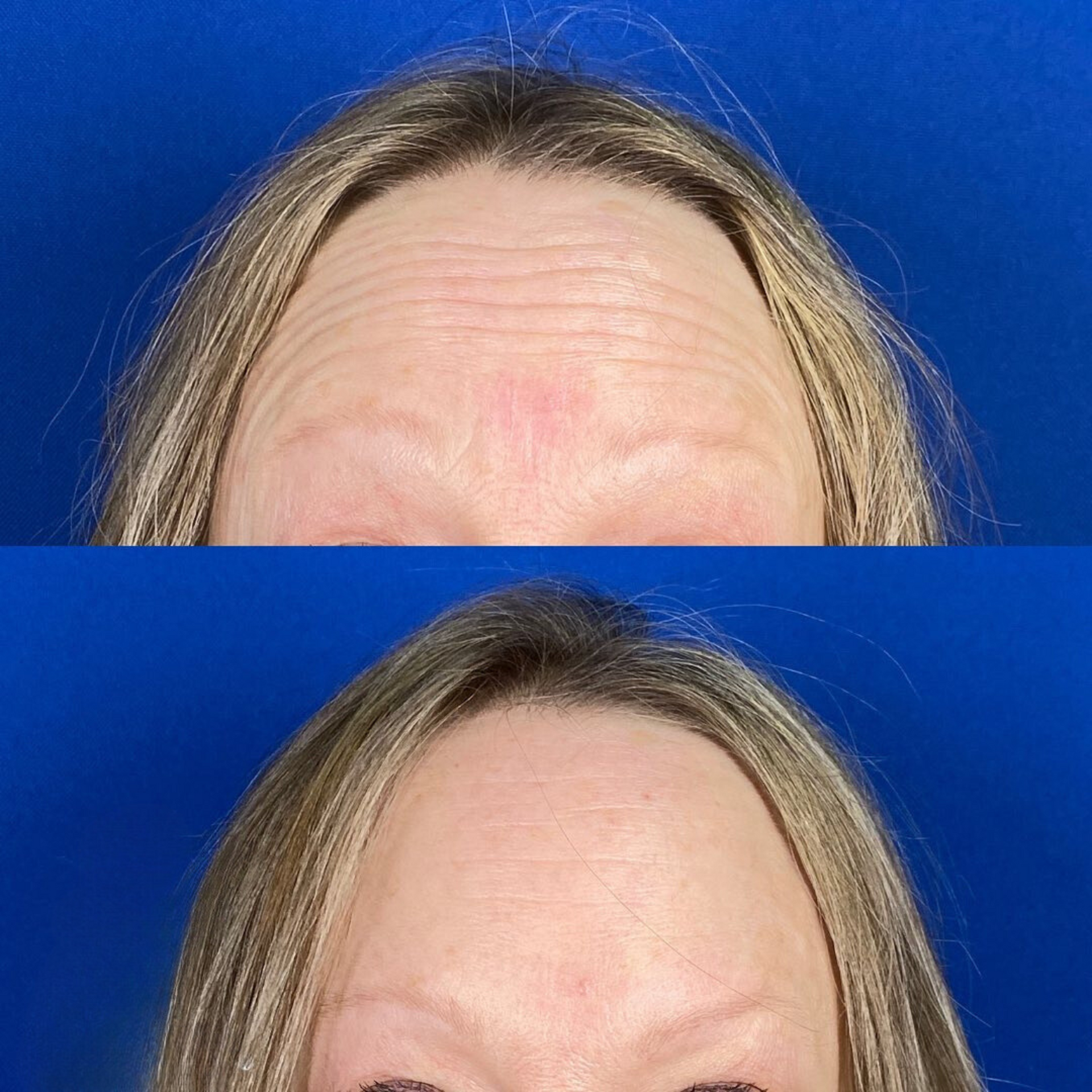 Neurotoxin before and after of a woman's forehead