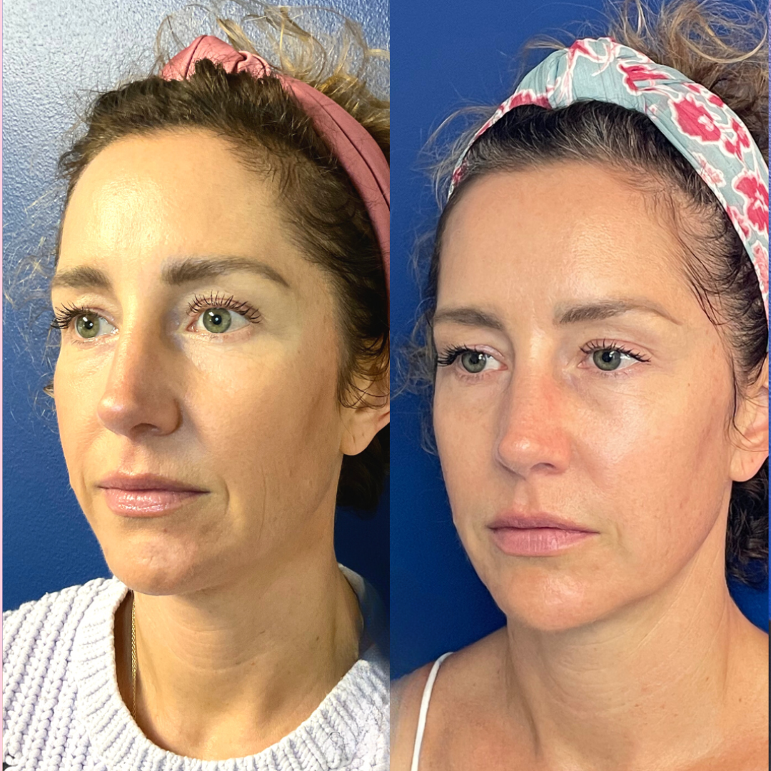 Sculptra before and after of a woman's face