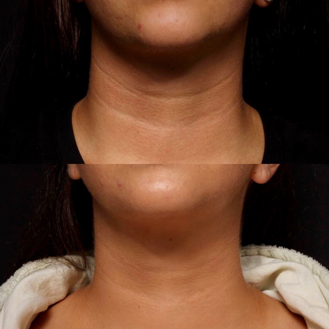 dermal filler before and after image