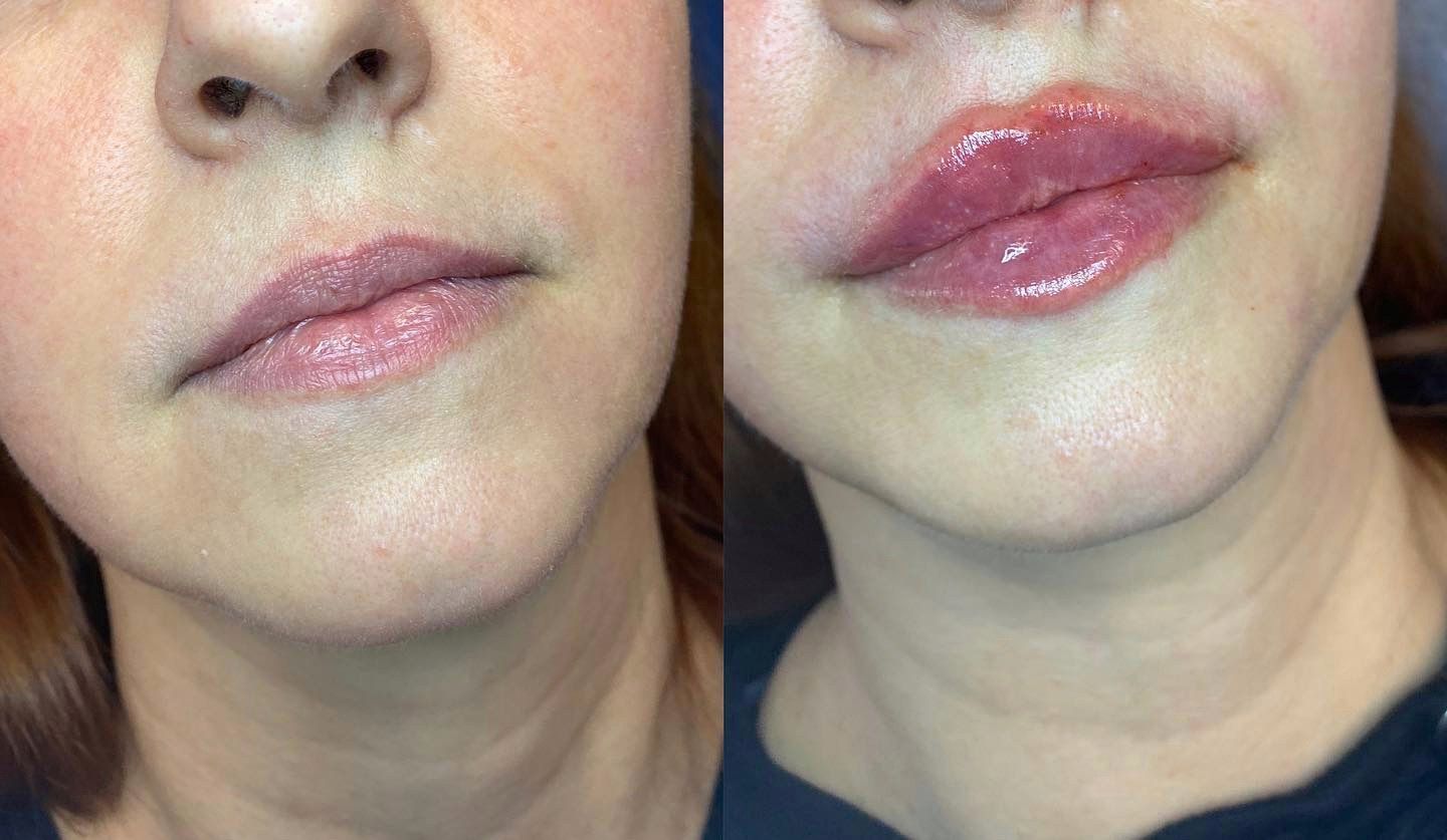 Lip filler before and after