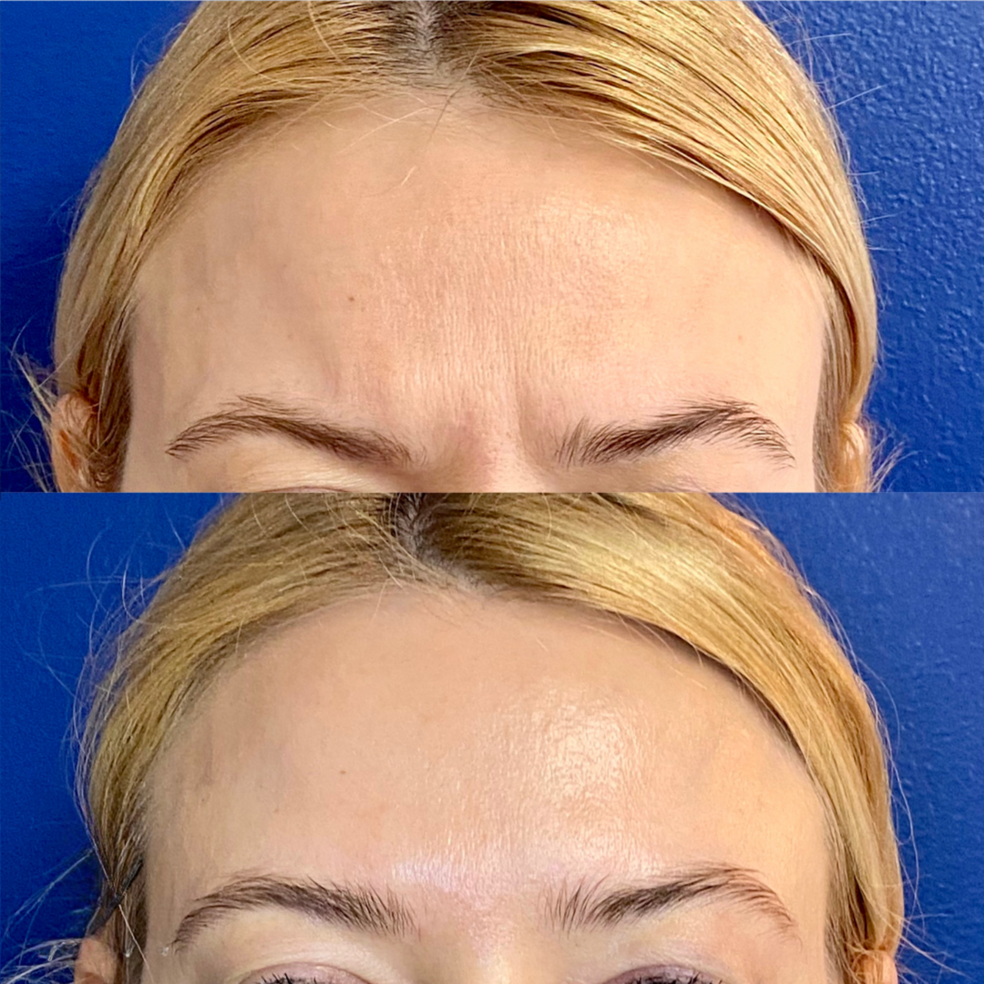 Neurotoxin before and after of a woman's forehead