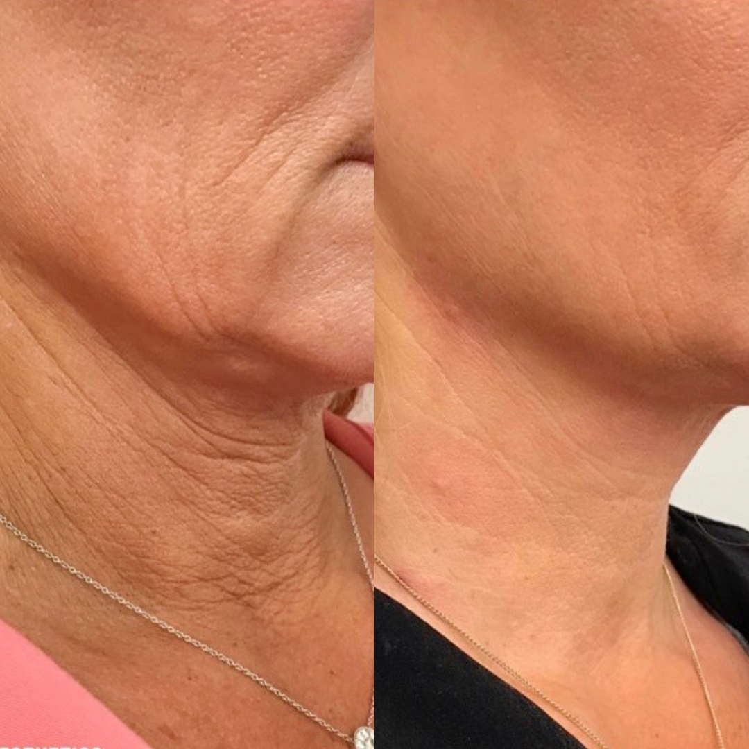 dermal filler before and after image