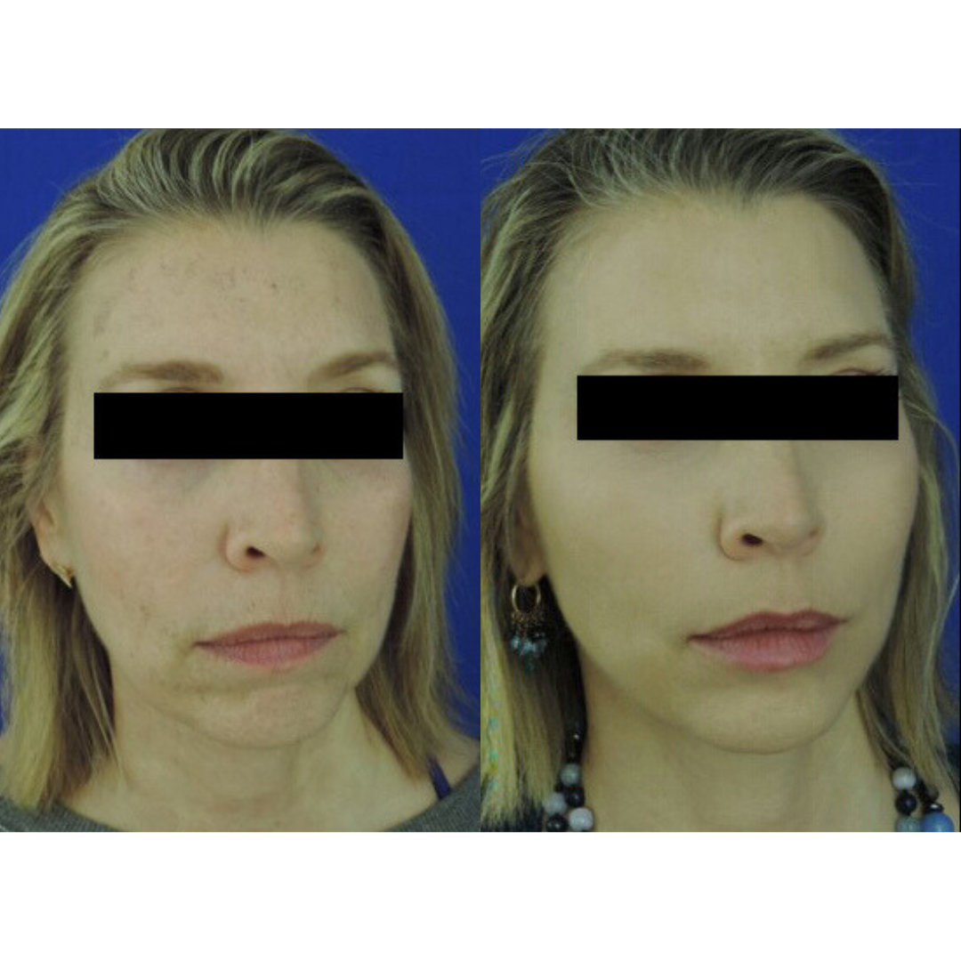 Dermal filler before and after of a woman's face