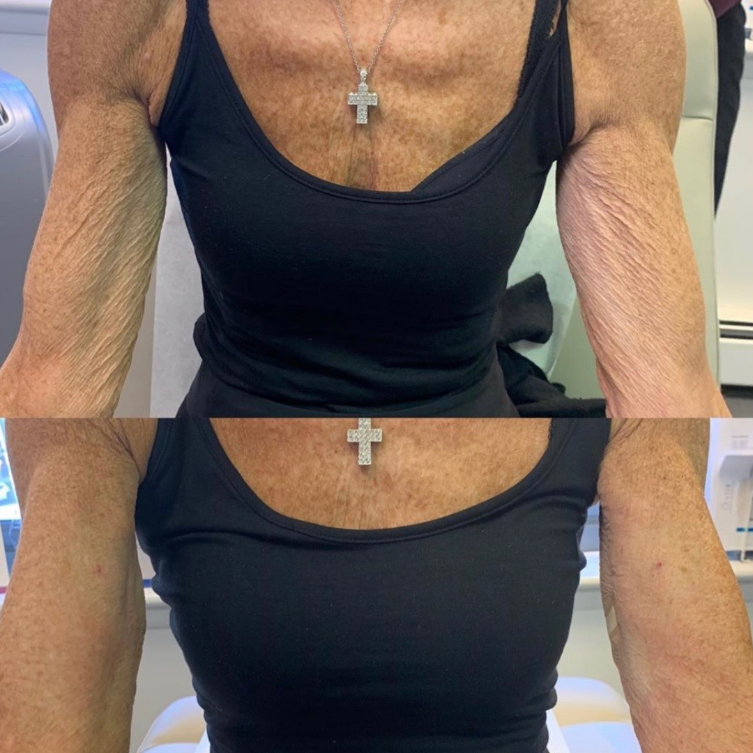 Filler before and after of a woman's arms