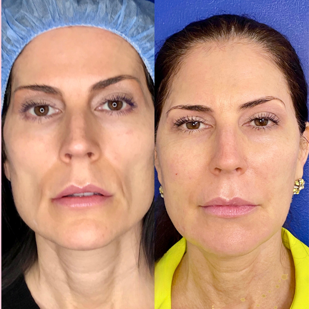 Sculptra before and after of a woman's face