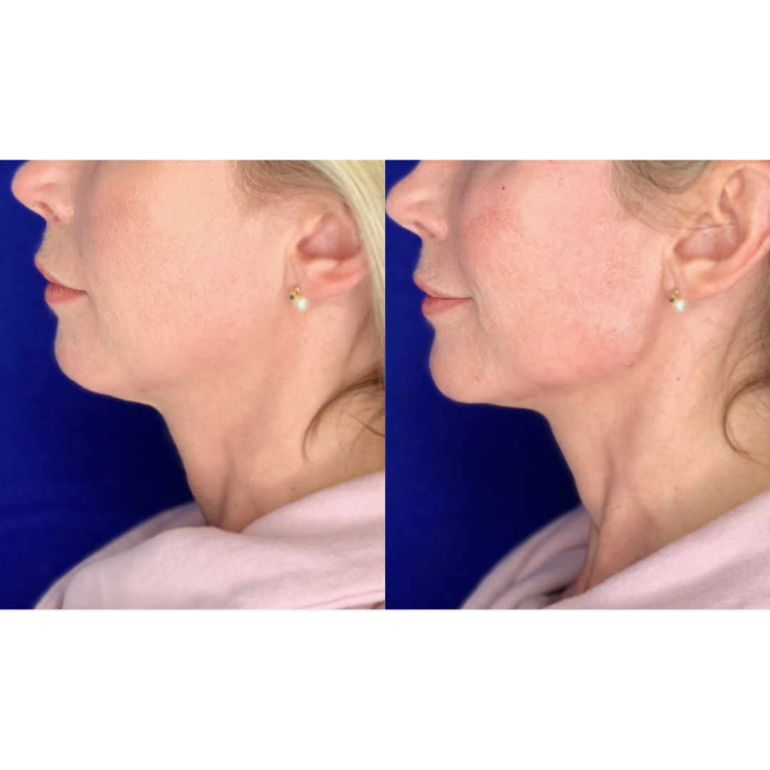 Dermal filler before and after of a woman's face