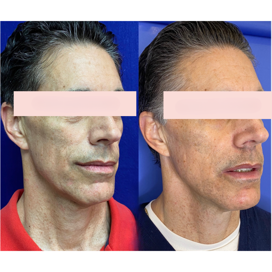 Sculptra before and after of a man's face