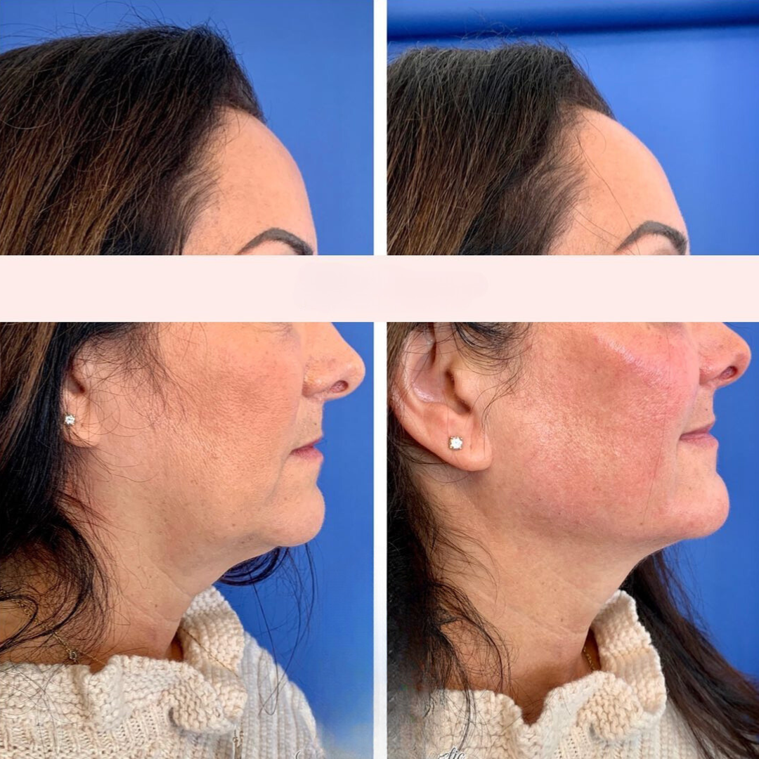 Dermal filler before and after of a woman's face