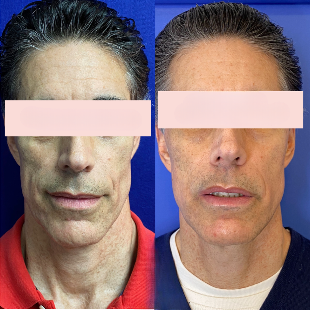 Sculptra before and after of a man's face