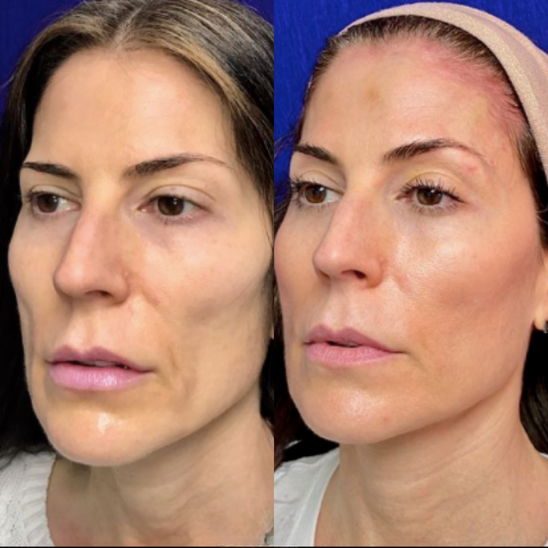 Sculptra before and after of a woman's face
