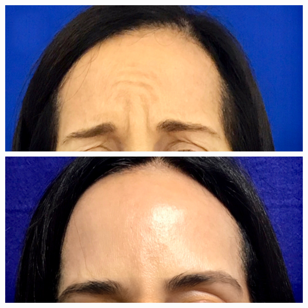 Neurotoxin before and after of a woman's forehead