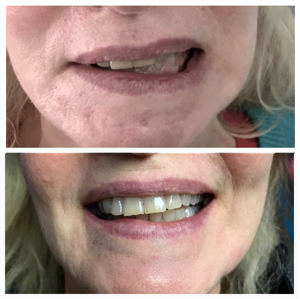 Neurotoxin before and after of a woman's mouth