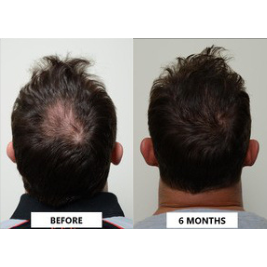 Hair restoration treatment before and after of a man's head