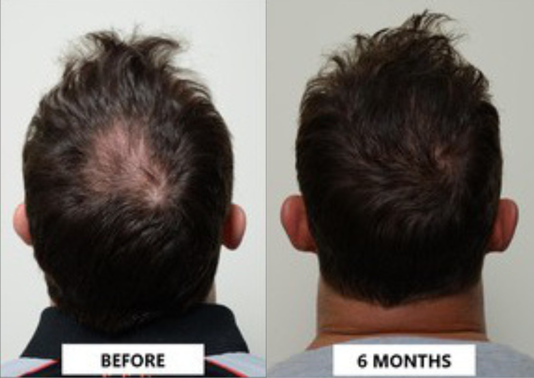 Hair restoration before and after of a man's head