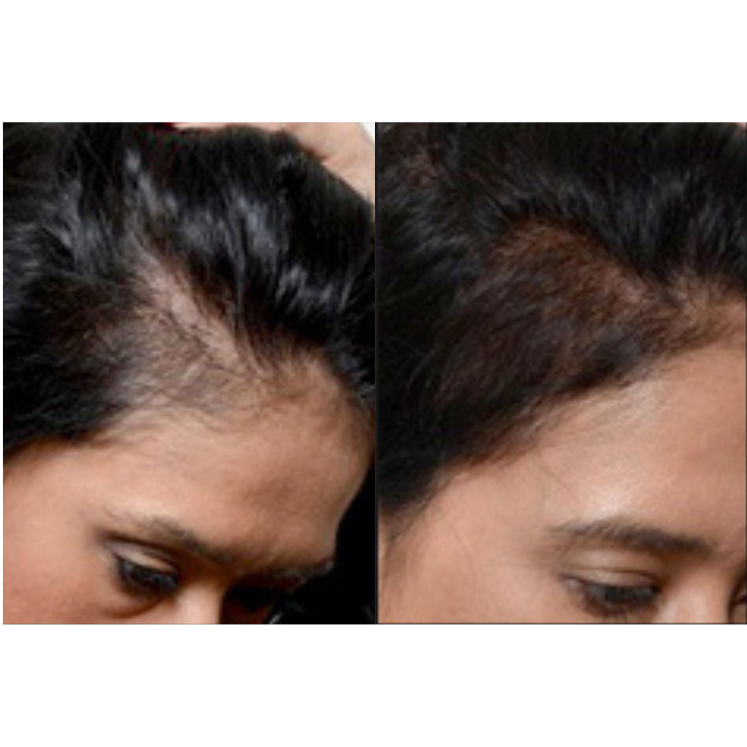 Hair restoration before and after of a woman's head