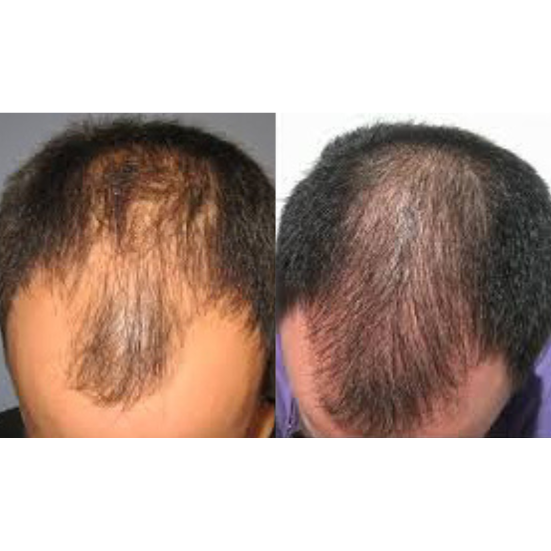 Hair restoration treatment before and after of a man's head