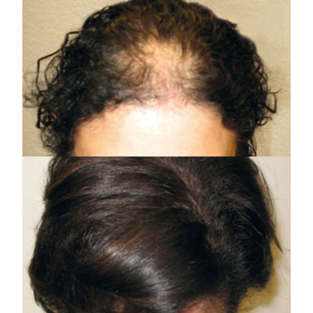 Hair restoration treatment before and after 
