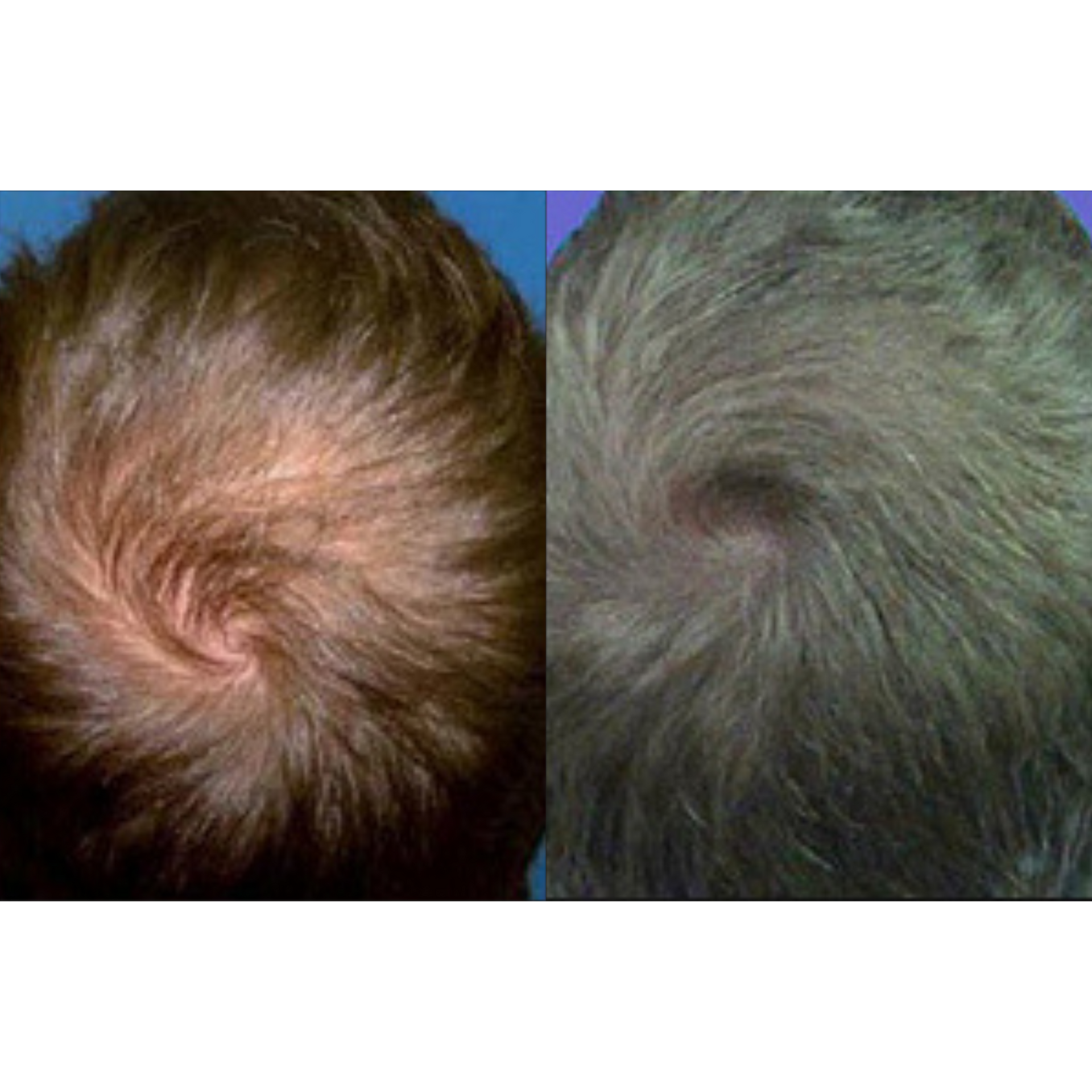 Hair restoration before and after of a man's head