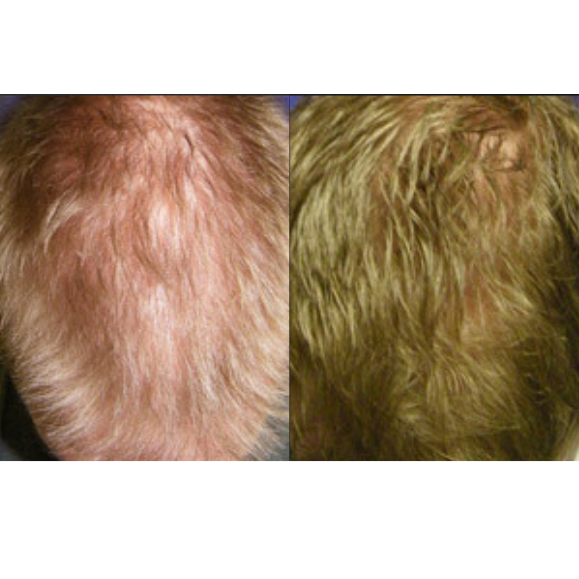 Hair restoration before and after of a man's head