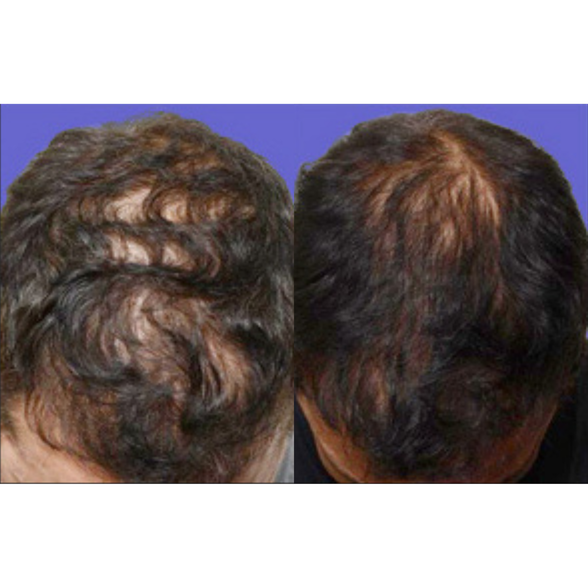 Hair restoration before and after of a man's head