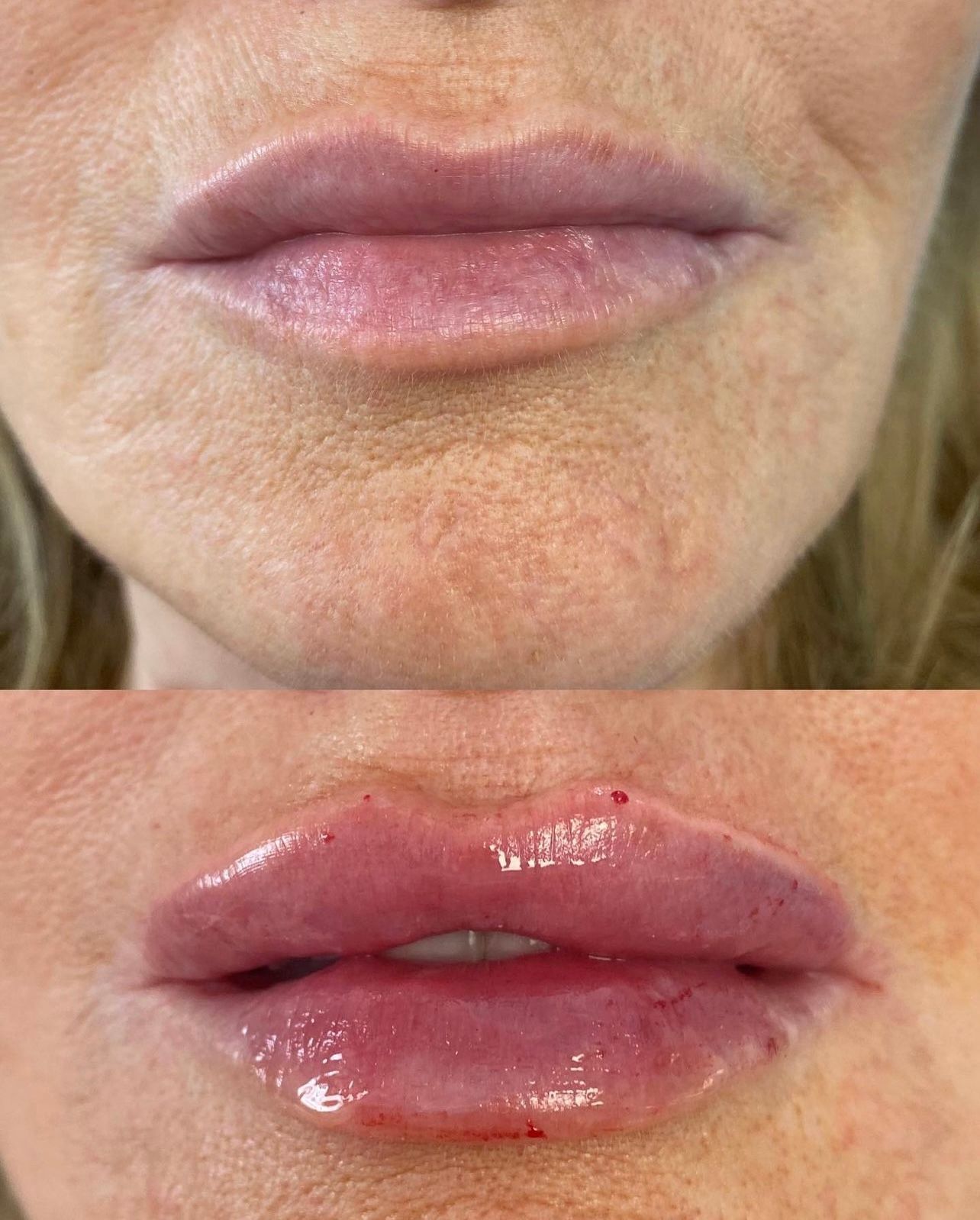 Lip filler before and after image