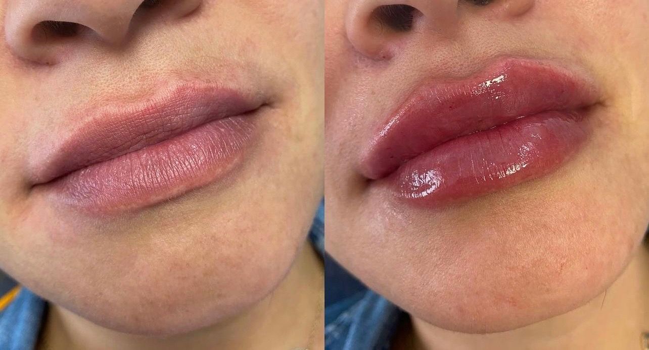 Lip filler before and after