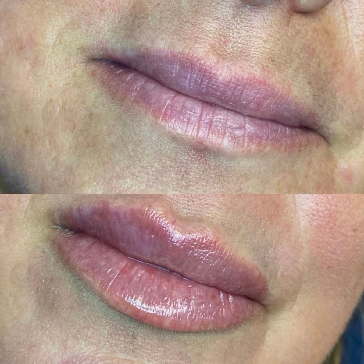 Lip filler before and after
