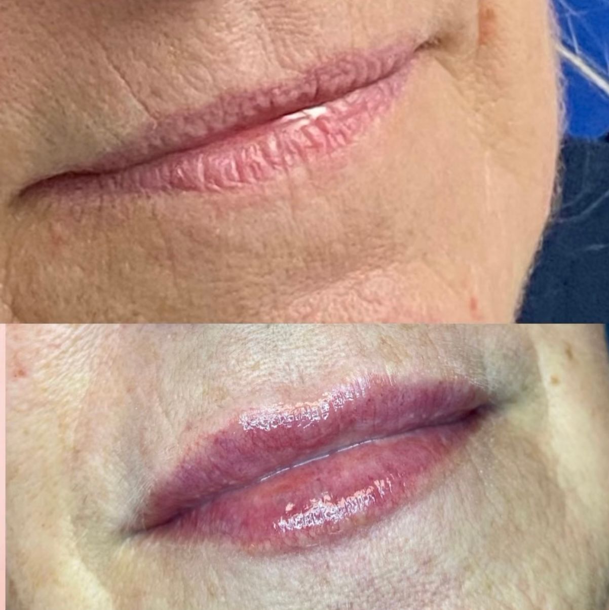 Lip filler before and after
