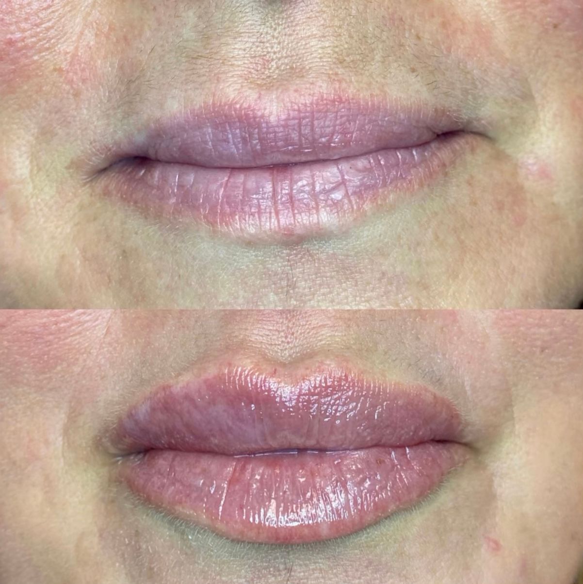 Lip filler before and after