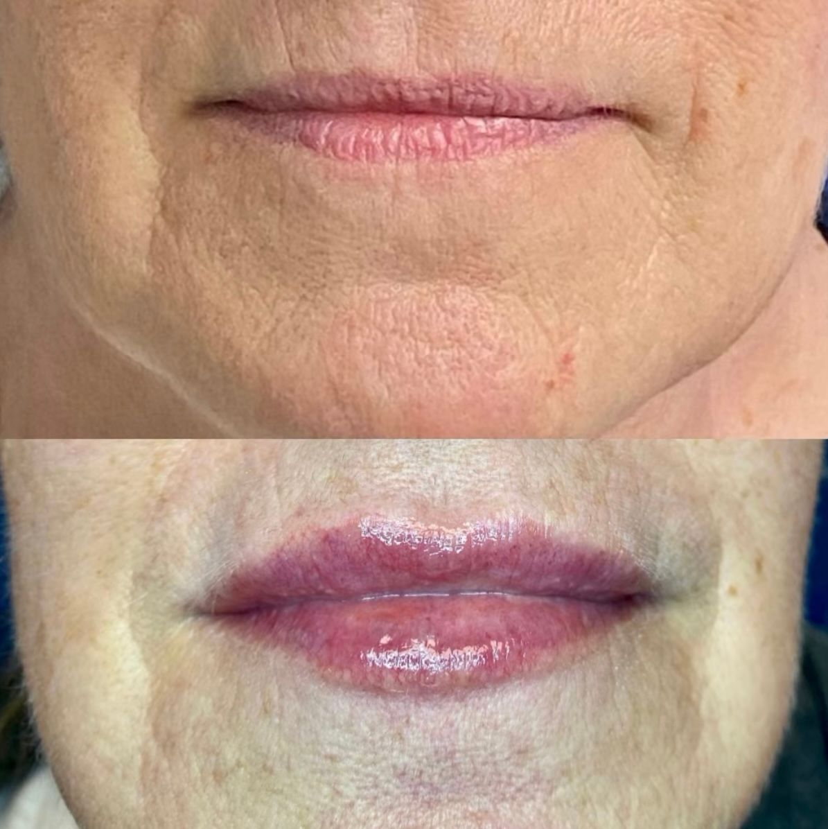 Lip filler before and after