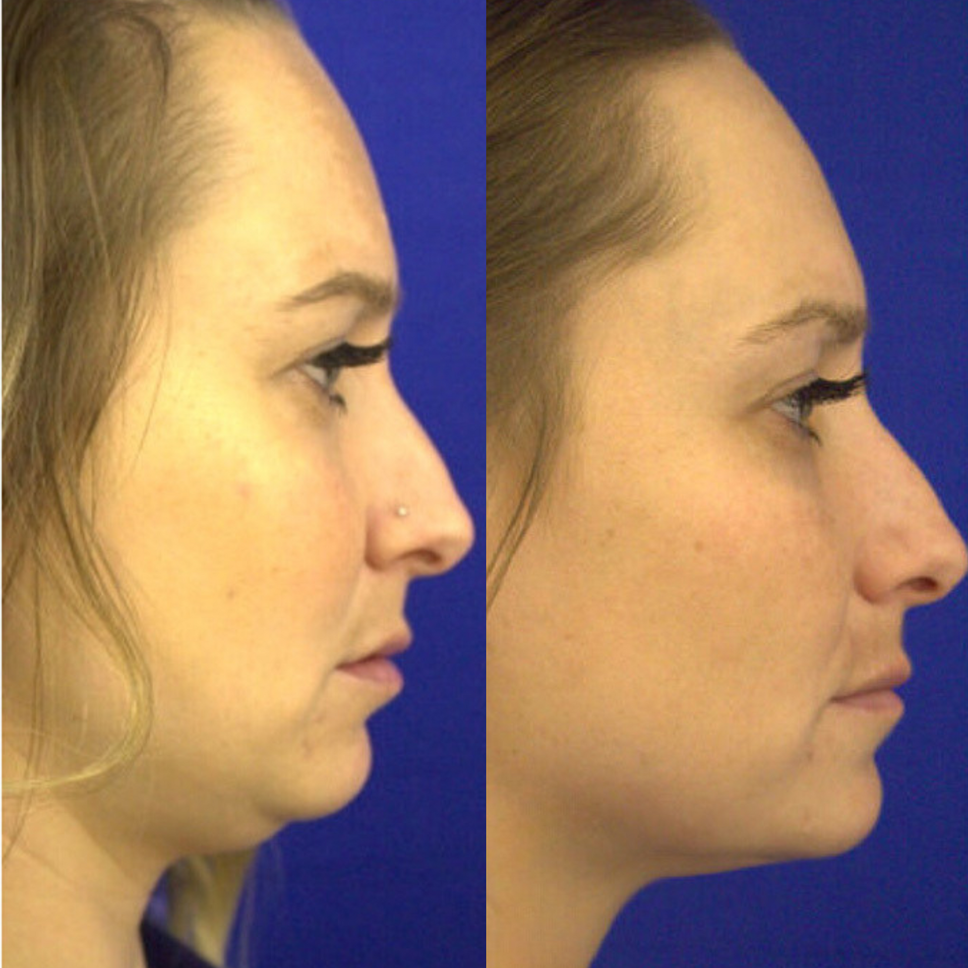 Kybella before and after of a woman's face