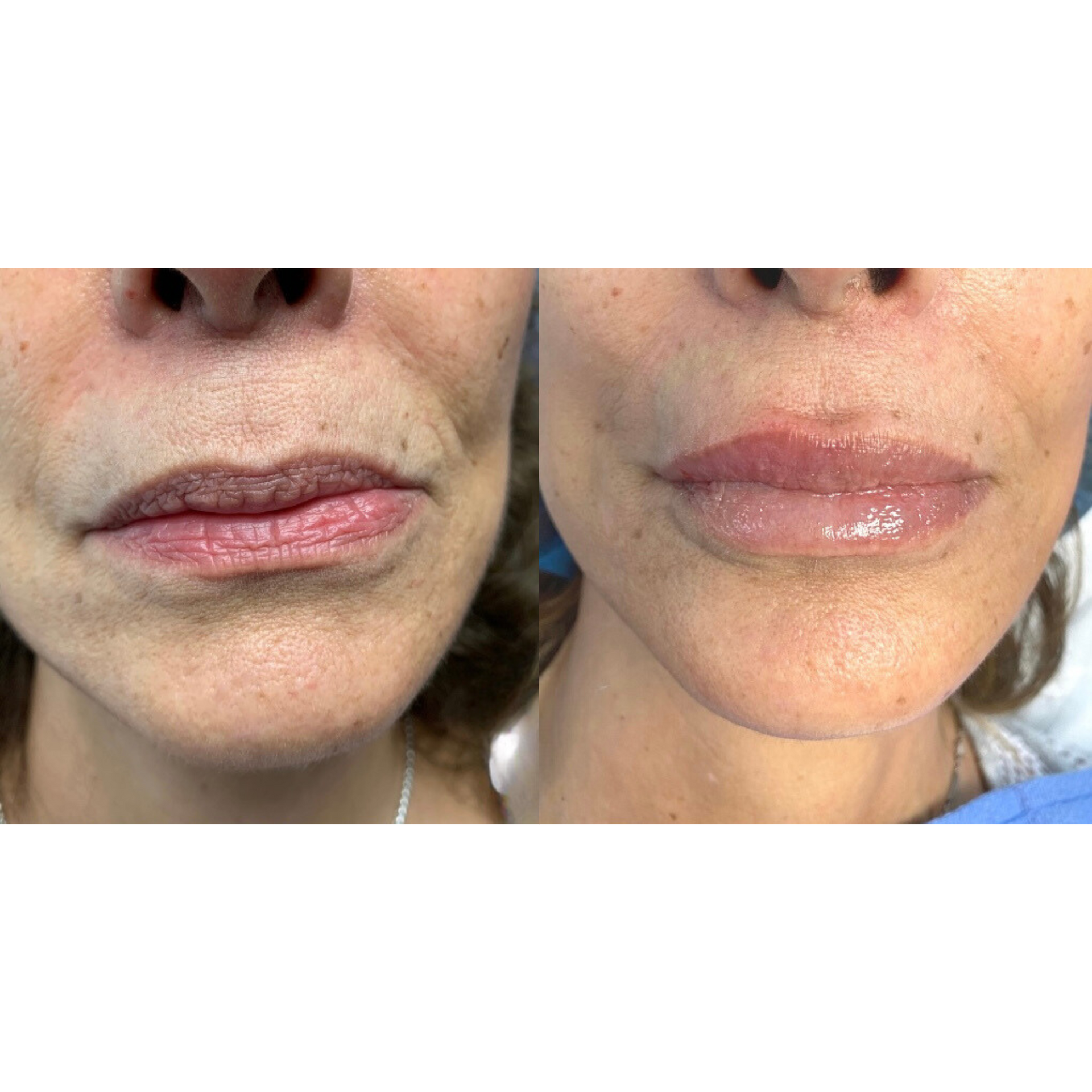 Lip filler before and after