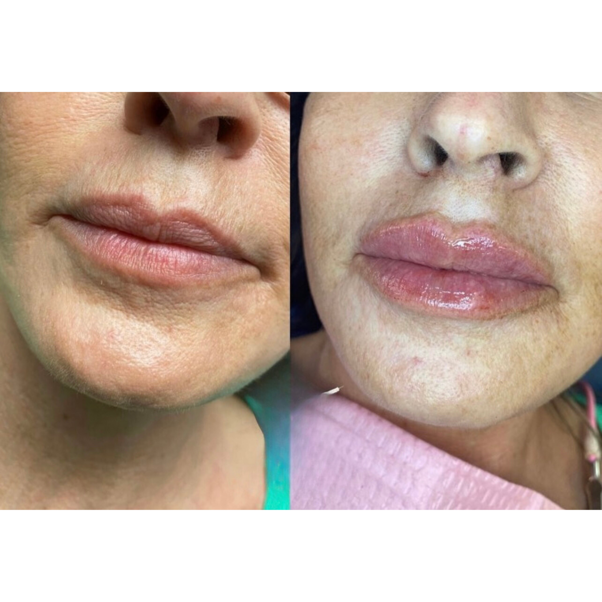 Lip filler before and after