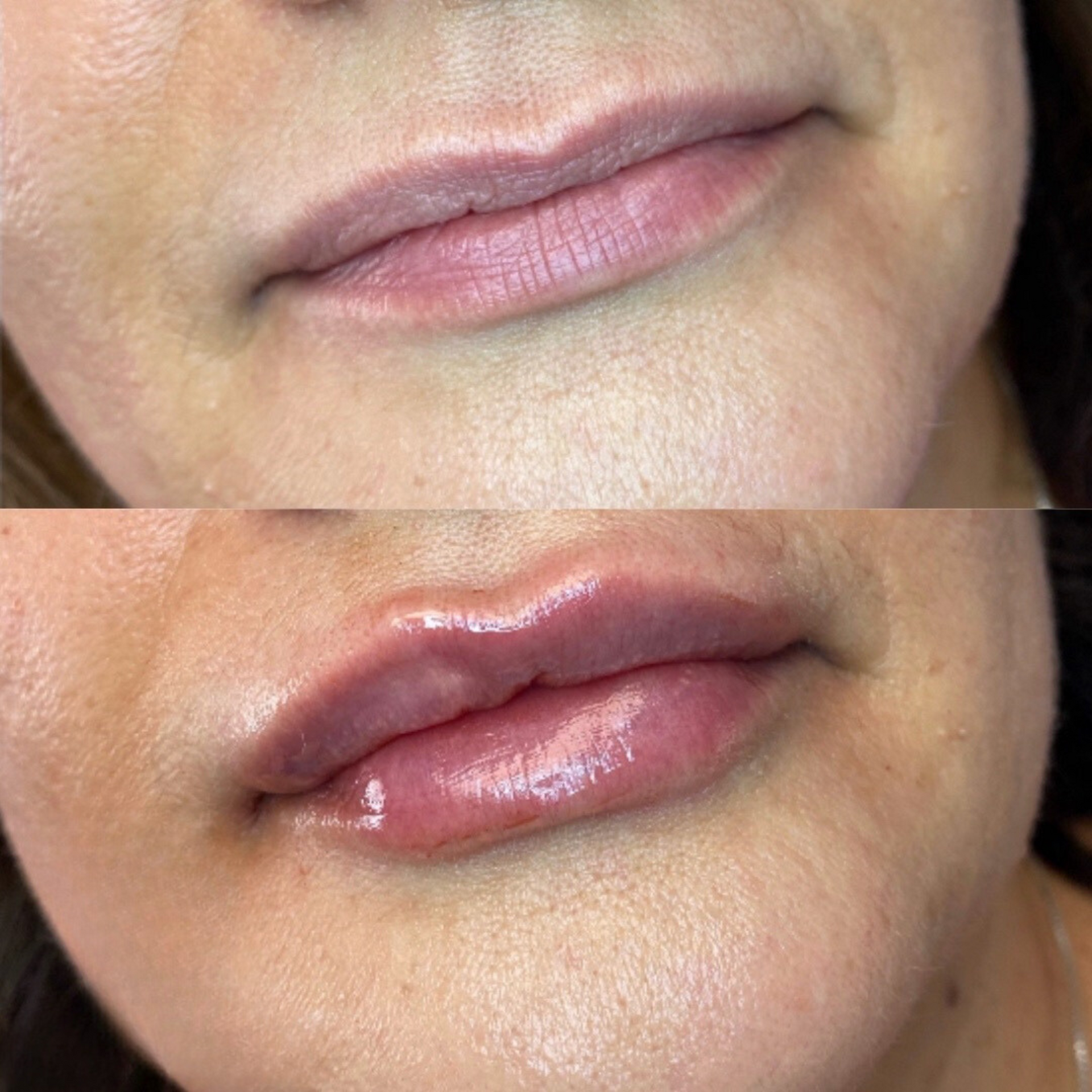 Lip filler before and after