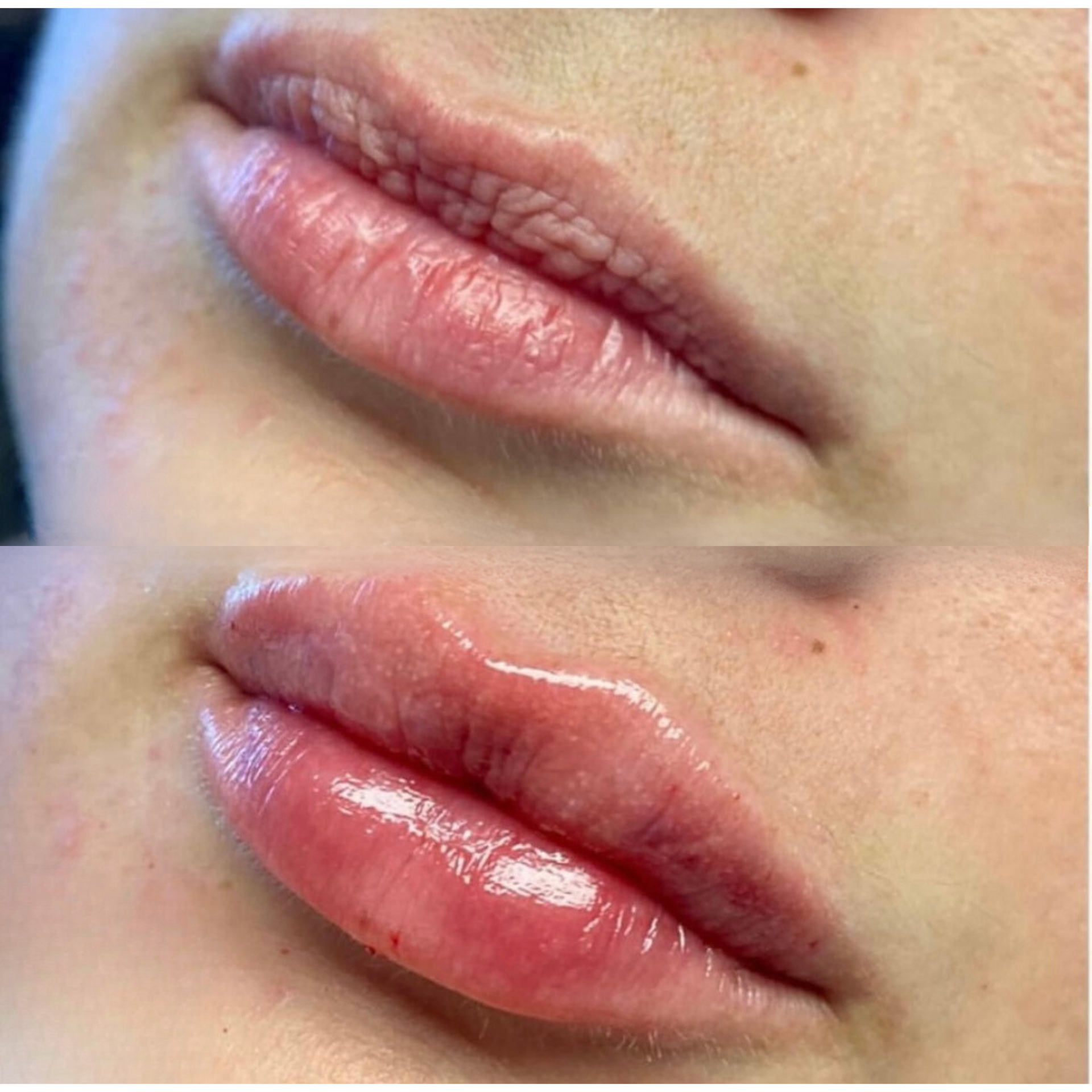 Lip filler before and after