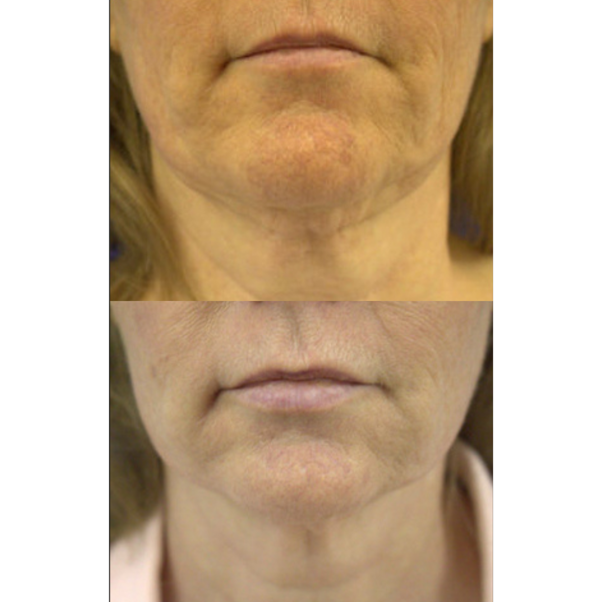 Neurotoxin before and after of a woman's face