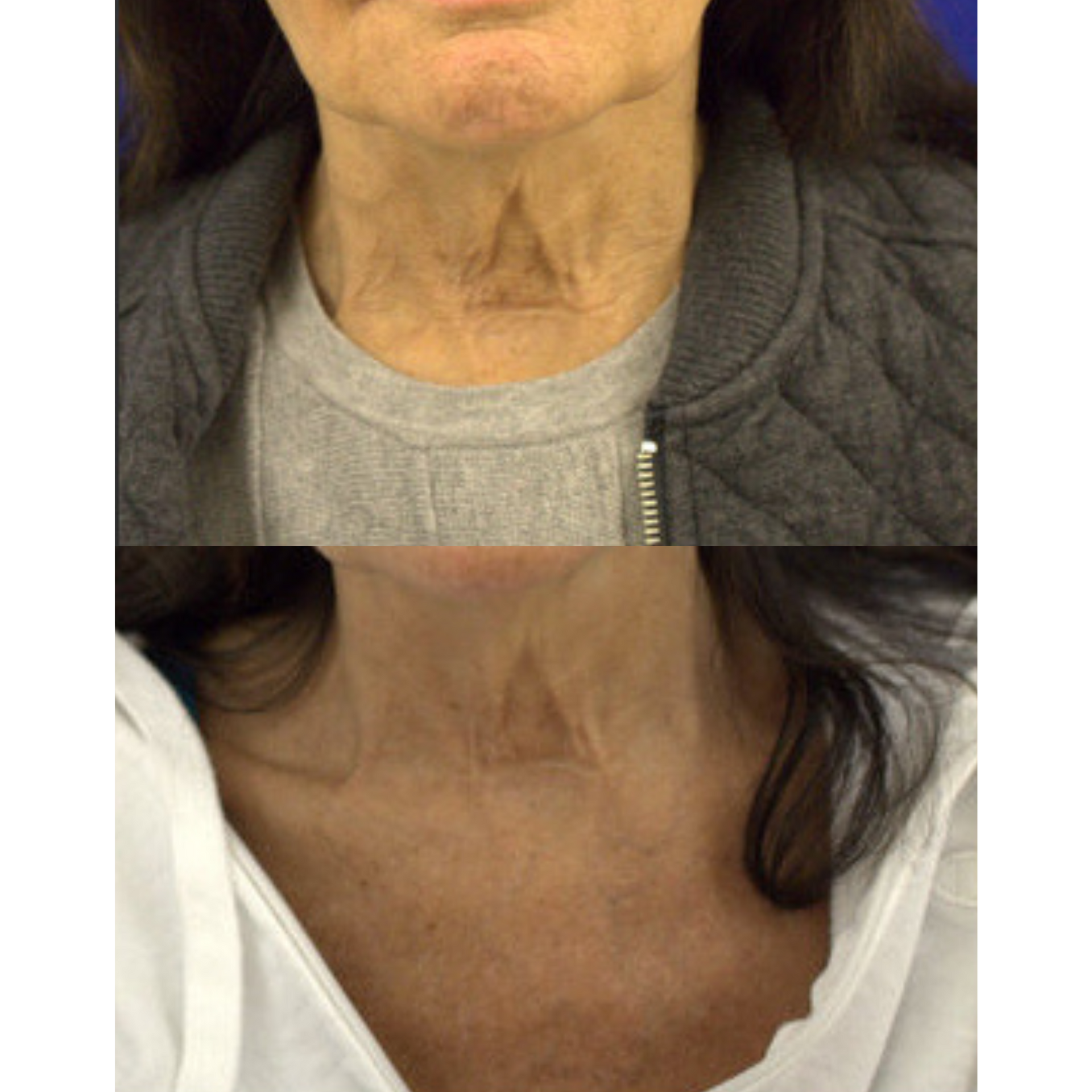Neurotoxin before and after of a woman's neck