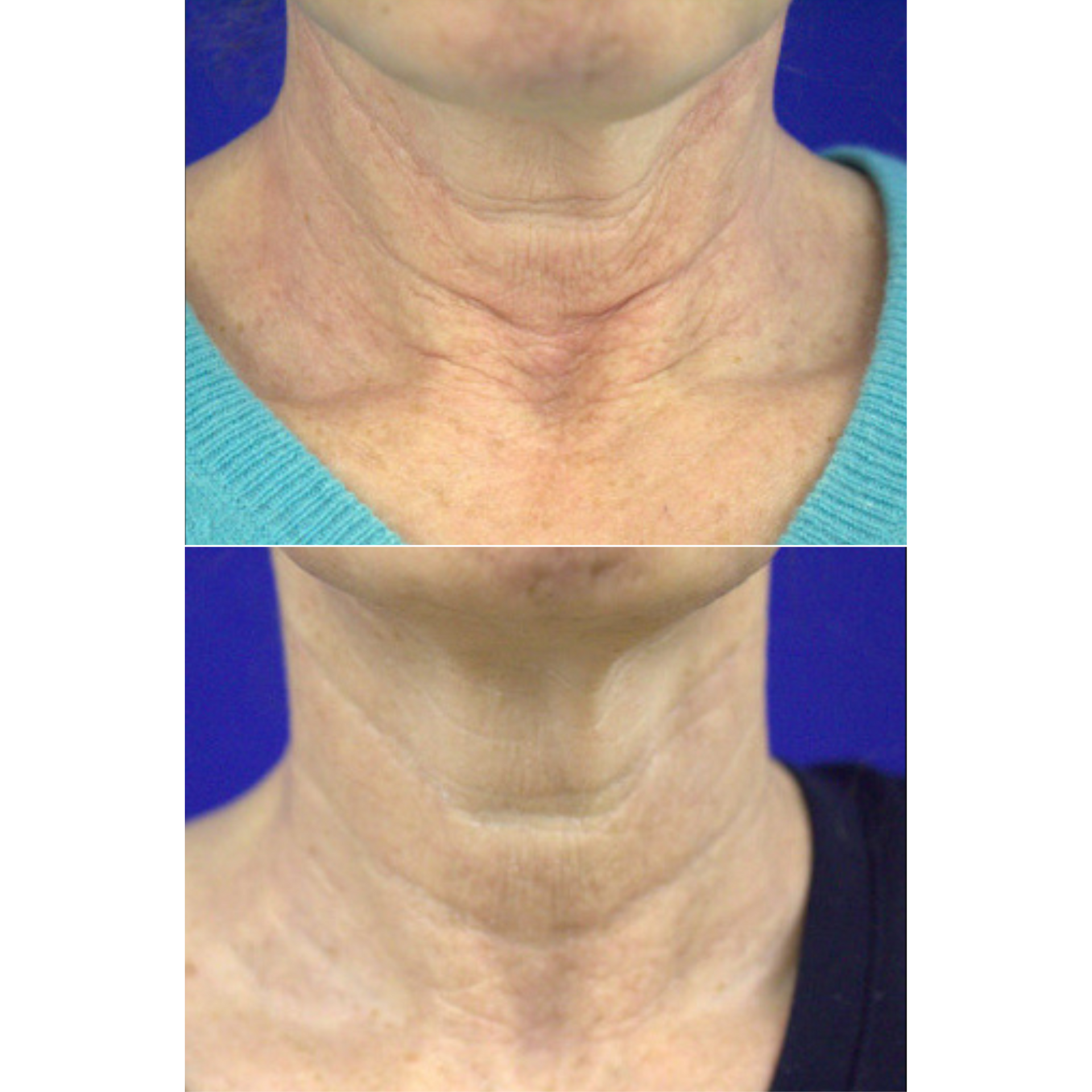Neurotoxin before and after of a woman's neck and chest